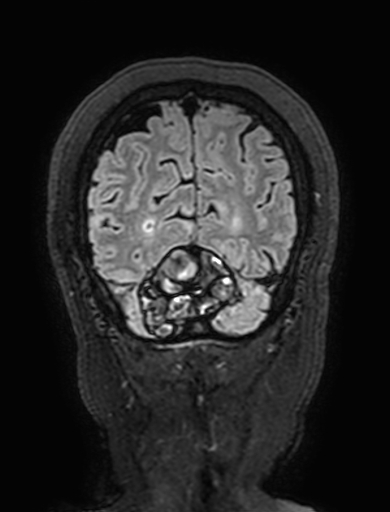 Cavernous hemangioma of the cerebellar falx (Radiopaedia 73025-83724 Coronal FLAIR 308).jpg