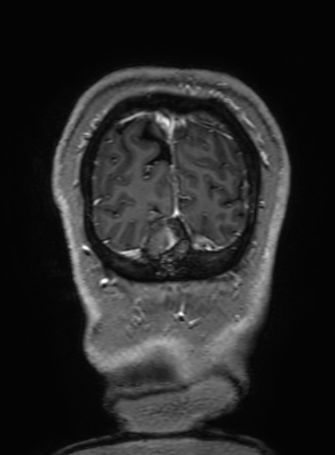 Cavernous hemangioma of the cerebellar falx (Radiopaedia 73025-83724 Coronal T1 C+ 347).jpg