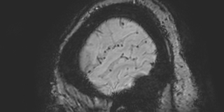 Cavernous hemangioma of the cerebellar falx (Radiopaedia 73025-83724 Sagittal BOLD 189).jpg