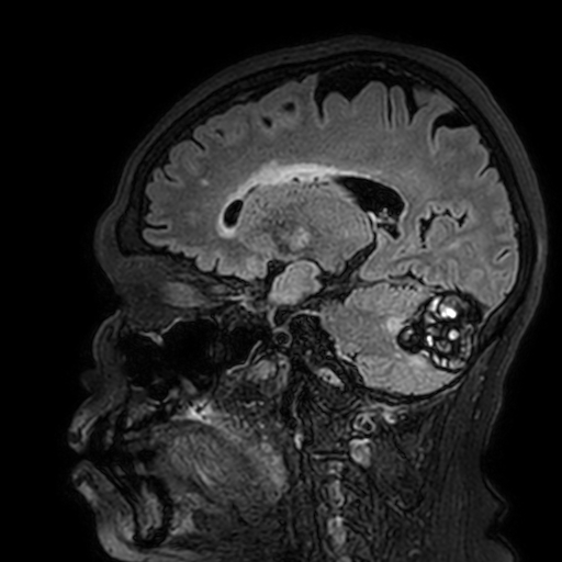 Cavernous hemangioma of the cerebellar falx (Radiopaedia 73025-83724 Sagittal FLAIR 137).jpg