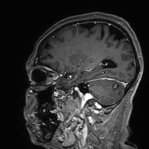 File:Cavernous hemangioma of the cerebellar falx (Radiopaedia 73025-83724 Sagittal T1 C+ 147).jpg