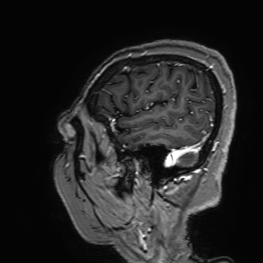 Cavernous hemangioma of the cerebellar falx (Radiopaedia 73025-83724 Sagittal T1 C+ 180).jpg