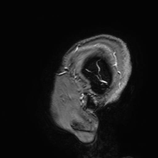 Cavernous hemangioma of the cerebellar falx (Radiopaedia 73025-83724 Sagittal T1 C+ 204).jpg