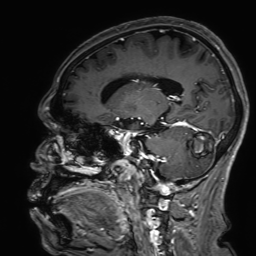 File:Cavernous hemangioma of the cerebellar falx (Radiopaedia 73025-83724 Sagittal T1 C+ 84).jpg