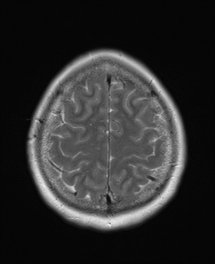 File:Cavernous sinus meningioma (Radiopaedia 63682-72367 Axial T2 19).jpg