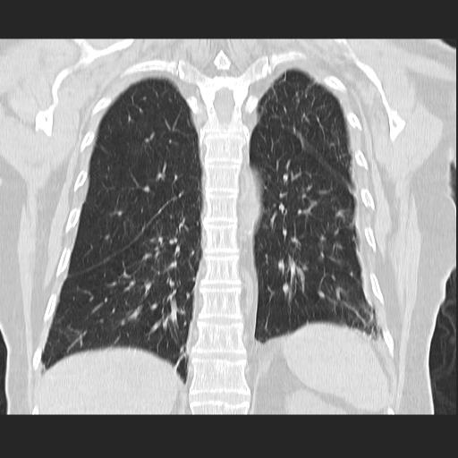 File:Cavitating pulmonary metastases (Radiopaedia 89545-106544 Coronal lung window 32).jpg