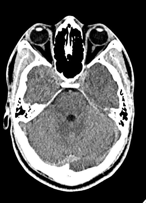 Cavum septum pellucidum and cavum vergae (Radiopaedia 77797-90060 Axial Brain Window 33).jpg