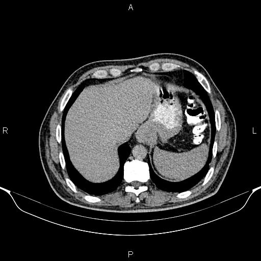 Cecal adenocarcinoma (Radiopaedia 85324-100916 Axial C+ delayed 14).jpg