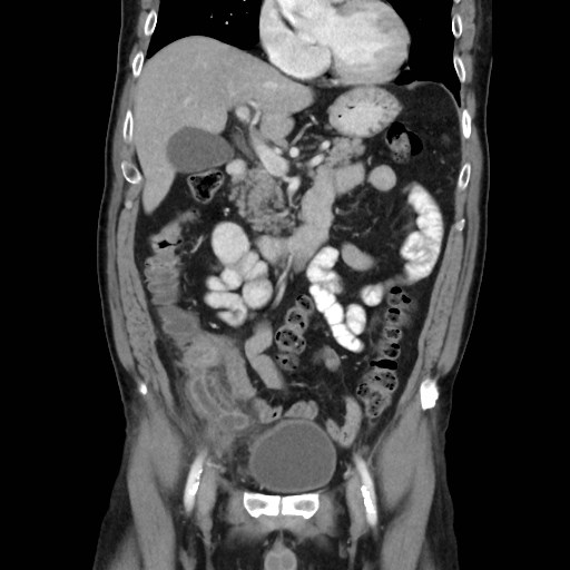 Cecal mass causing appendicitis (Radiopaedia 59207-66531 B 21).jpg