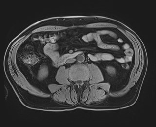 Cecal mass causing appendicitis (Radiopaedia 59207-66532 Axial T1 75).jpg