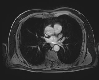Cecal mass causing appendicitis (Radiopaedia 59207-66532 T1 C+ PV phase 2).jpg
