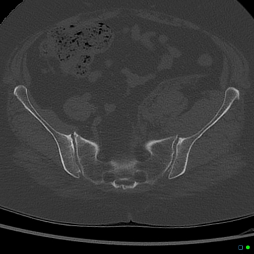 Central fracture-dislocation of the acetabulum (Radiopaedia 36578-38150 Axial bone window 18).jpg
