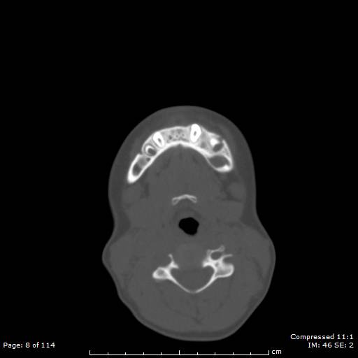 File:Central giant cell granuloma (Radiopaedia 45612-49754 Axial bone window 4).jpg
