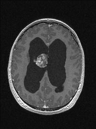 Central neurocytoma (Radiopaedia 56690-63469 Axial T1 C+ 110).jpg