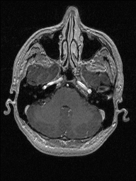 Central neurocytoma (Radiopaedia 56690-63469 Axial T1 C+ 39).jpg
