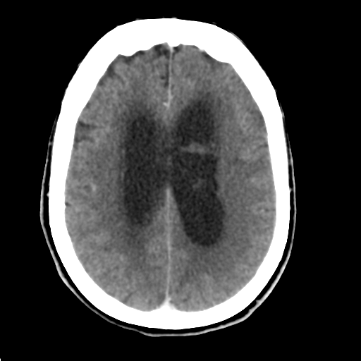 Central neurocytoma (Radiopaedia 65317-74346 Axial C+ delayed 33).png