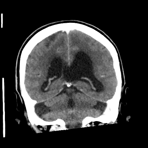 Central neurocytoma (Radiopaedia 65317-74346 Coronal C+ delayed 39).png