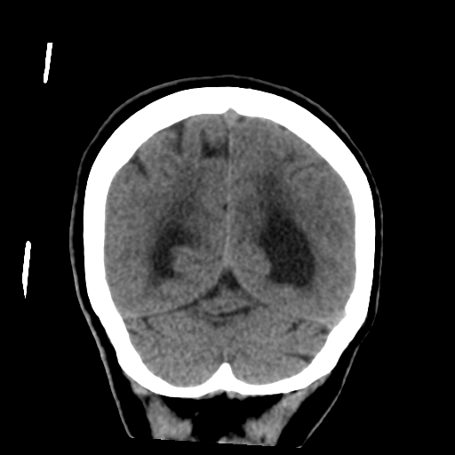 Central neurocytoma (Radiopaedia 65317-74346 Coronal non-contrast 47).png