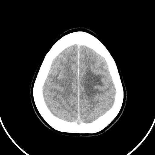 Central neurocytoma (Radiopaedia 84497-99871 Axial non-contrast 44).jpg