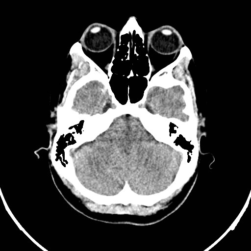 Central neurocytoma (Radiopaedia 84497-99871 Axial non-contrast 8).jpg