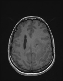 Central neurocytoma (Radiopaedia 84497-99872 Axial T1 138).jpg