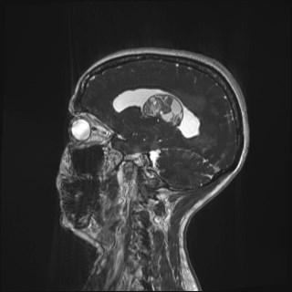 File:Central neurocytoma (Radiopaedia 84497-99872 Sagittal CISS 18).jpg