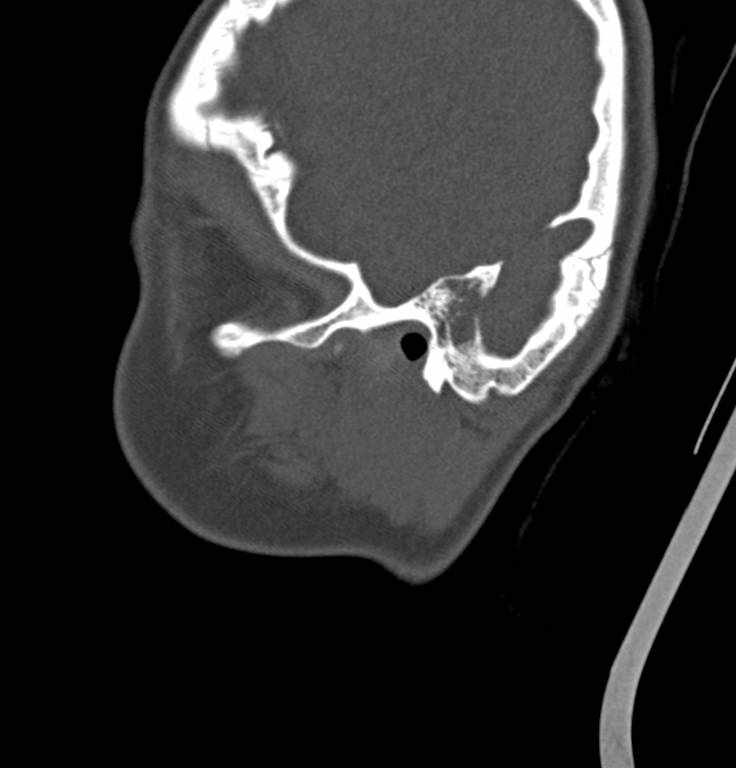 Cerebellar abscess (Radiopaedia 73727-84527 Sagittal bone window 35).jpg