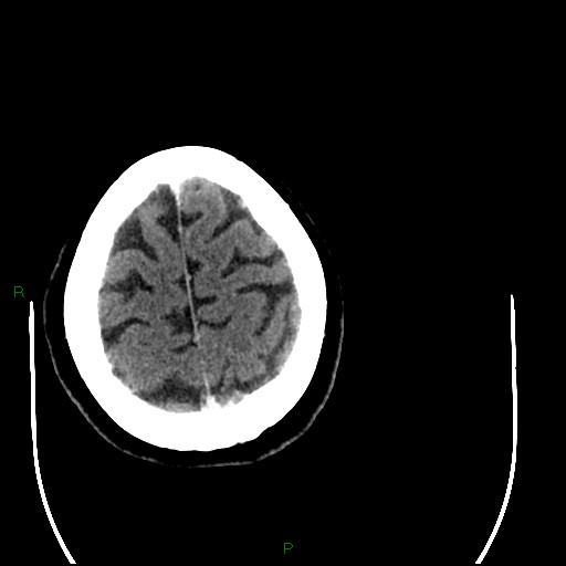 Cerebellar abscess (Radiopaedia 78135-90671 Axial C+ delayed 94).jpg