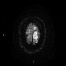 Cerebellar abscess (Radiopaedia 78135-90678 Axial DWI 28).jpg