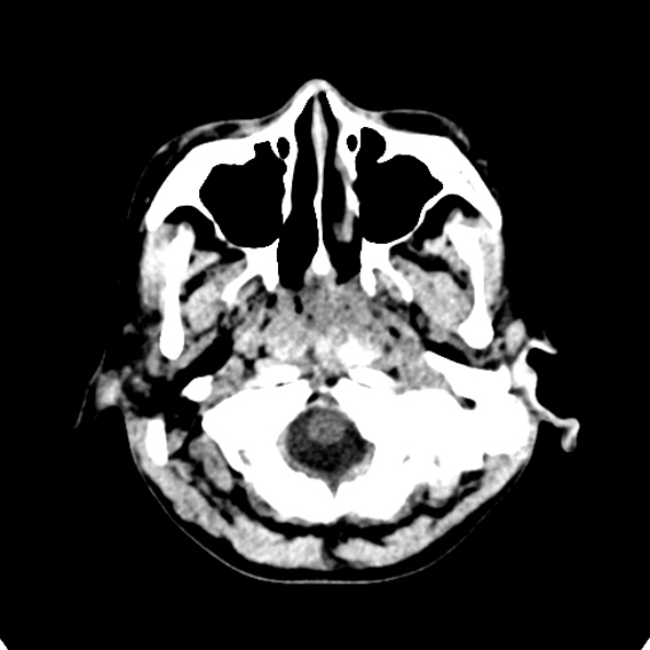 Cerebellar abscess secondary to mastoiditis (Radiopaedia 26284-26412 Axial non-contrast 11).jpg
