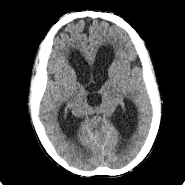 Cerebellar abscess secondary to mastoiditis (Radiopaedia 26284-26412 Axial non-contrast 73).jpg
