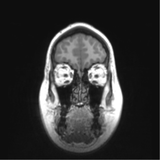 Cerebellar ependymoma complicated by post-operative subdural hematoma (Radiopaedia 83322-97736 Coronal T1 9).png