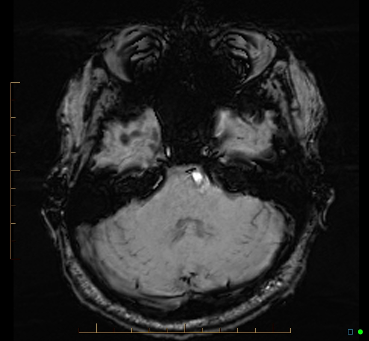 Cerebellar gangliocytoma (Radiopaedia 65377-74422 Axial SWI 14).jpg