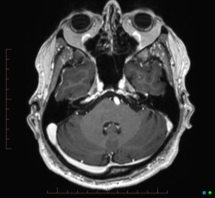 Cerebellar gangliocytoma (Radiopaedia 65377-74422 Axial T1 C+ 27).jpg