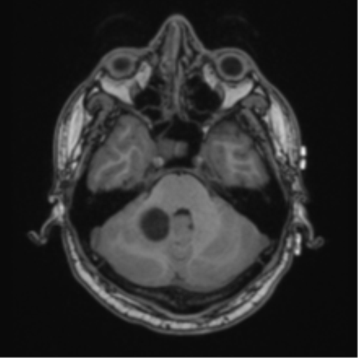 Cerebellar hemangioblastomas and pituitary adenoma (Radiopaedia 85490-101176 Axial T1 20).png