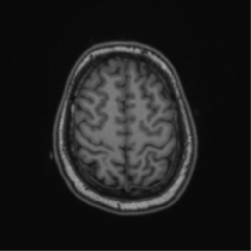 Cerebellar hemangioblastomas and pituitary adenoma (Radiopaedia 85490-101176 Axial T1 60).png