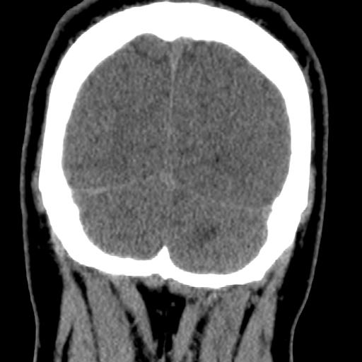 Cerebellar infarction (Radiopaedia 16625-16327 Coronal non-contrast 39).jpg