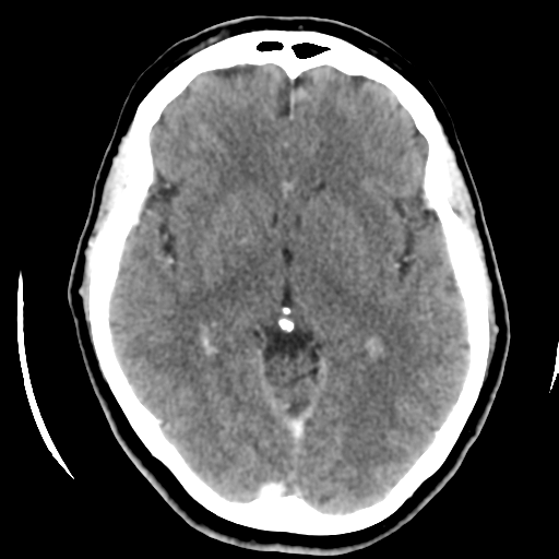 Cerebellar metastasis (cystic appearance) (Radiopaedia 41395-44258 B 24).png