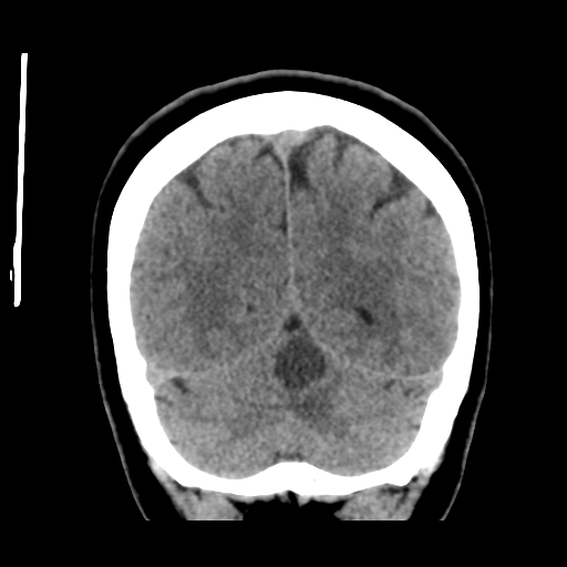 Cerebellar metastasis (cystic appearance) (Radiopaedia 41395-44258 Coronal non-contrast 48).png