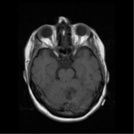 File:Cerebellar metastasis (cystic appearance) (Radiopaedia 41395-44262 Axial T1 8).png