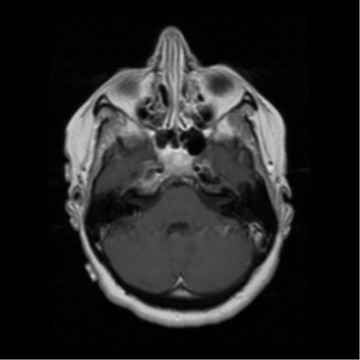 File:Cerebellar metastasis (cystic appearance) (Radiopaedia 41395-44262 Axial T1 C+ 5).png