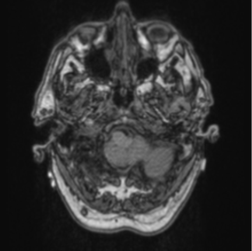 Cerebellar metastasis from lung adenocarcinoma (Radiopaedia 86690-102829 Axial T1 14).png