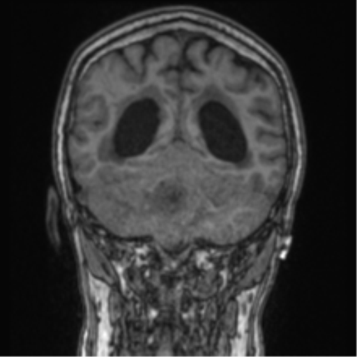 Cerebellar metastasis from lung adenocarcinoma (Radiopaedia 86690-102829 Coronal T1 35).png
