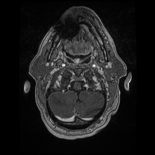 Cerebellar metastasis of pulmonary adenocarcinoma, cavernous venous malformation, and developmental venous anomaly (Radiopaedia 85827-101661 Axial T1 C+ 15).jpg