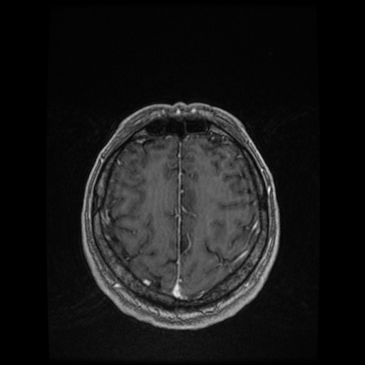 Cerebellar metastasis of pulmonary adenocarcinoma, cavernous venous malformation, and developmental venous anomaly (Radiopaedia 85827-101661 Axial T1 C+ 74).jpg