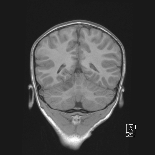 Cerebellar stroke (Radiopaedia 32202-33150 Coronal T1 43).png