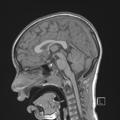 File:Cerebellar stroke (Radiopaedia 32202-33150 Sagittal T1 C+ 26).png