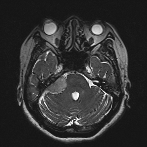 Cerebellopontine angle meningioma (Radiopaedia 53561-59591 Axial 3D volume T2 67).jpg