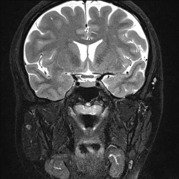 File:Cerebellopontine angle meningioma (Radiopaedia 53561-59591 Coronal T2 1).jpg