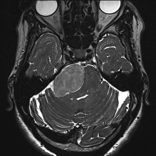 Cerebellopontine angle meningioma (Radiopaedia 72983-83680 Axial FIESTA 41).jpg